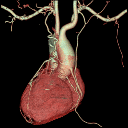 心脏CT血管造影