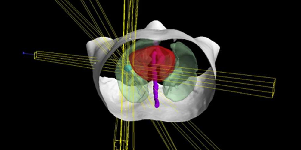 trubeam targeting tumor