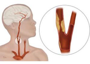 颈动脉疾病